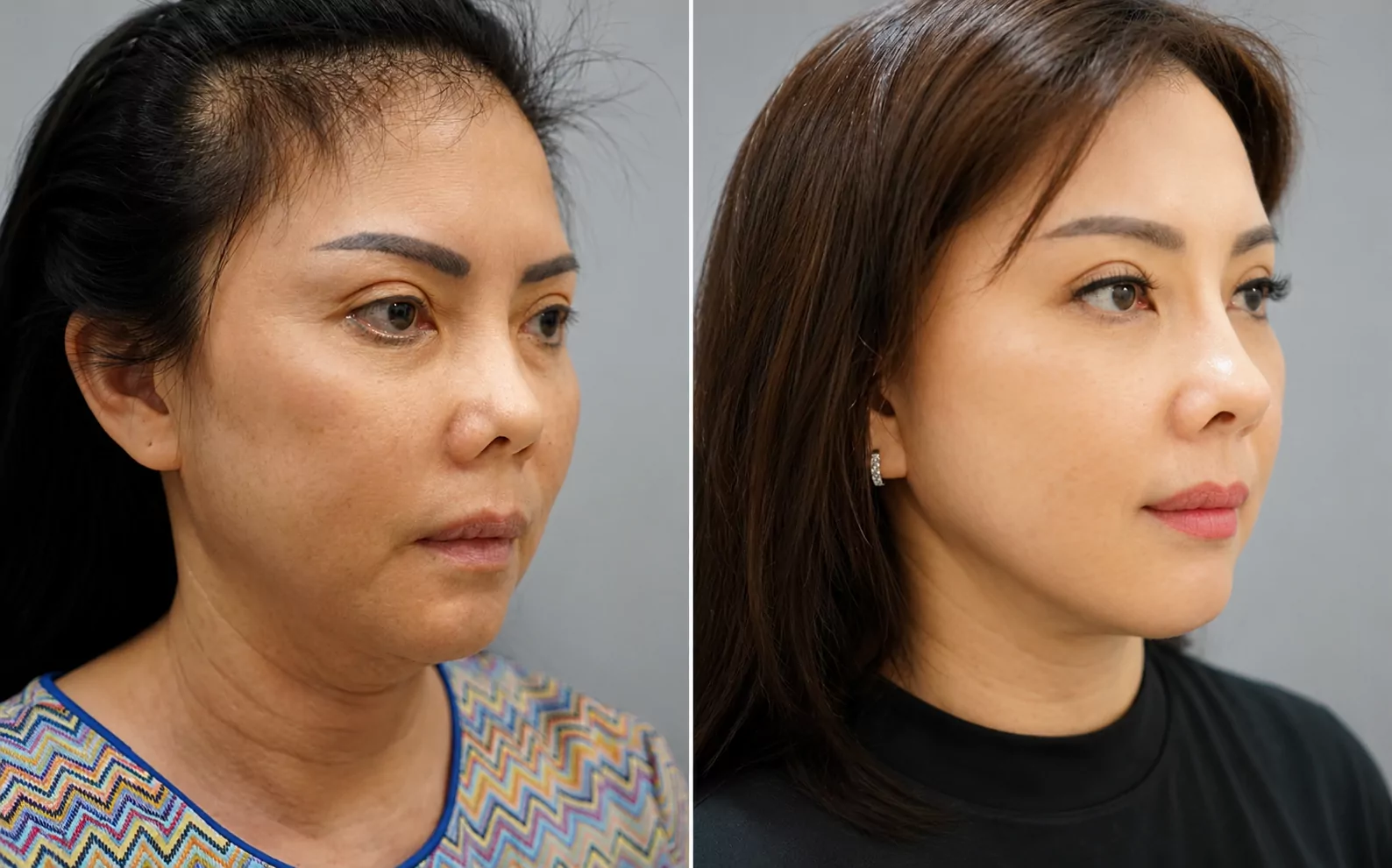 Ms Linh — before and after Tarik Wajah