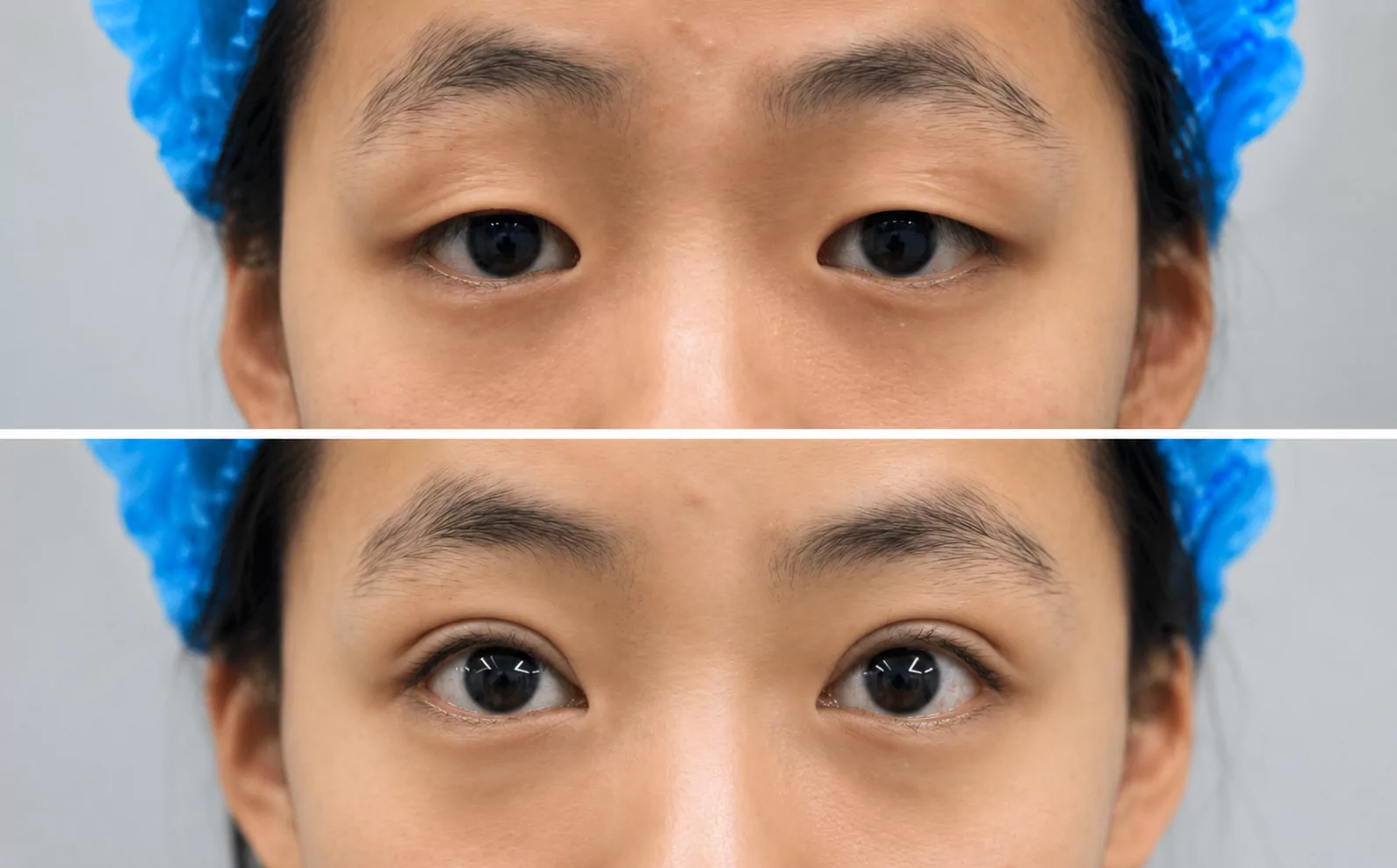 Ms Dewi — before and after Operasi Kelopak Mata